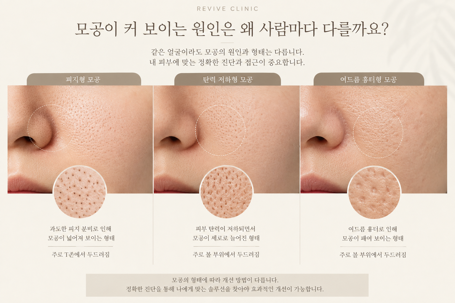 피지형 탄력 저하형 여드름 흉터형 얼굴 모공 차이 비교